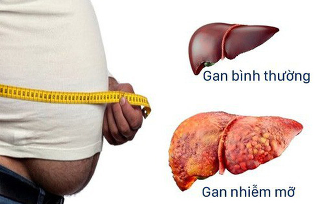 Fatty Liver - Hình ảnh minh họa